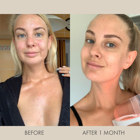 Selfcare Social LED Light Therapy Mask before and after